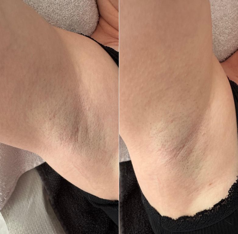 EPILATION AISSELLES AVANT-APRES CHEZ BEAUTE SANTE INSTITUT