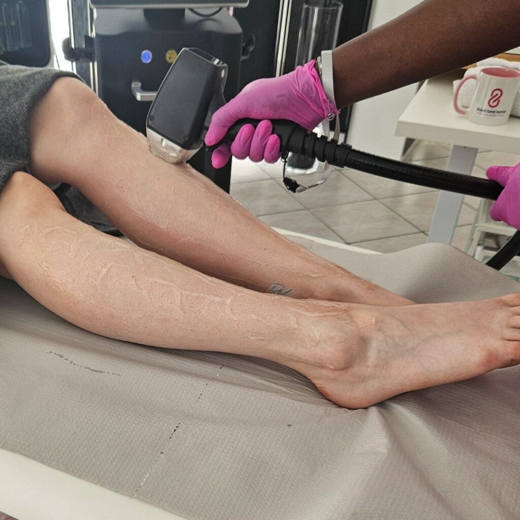 épilation laser sur demi-jambes