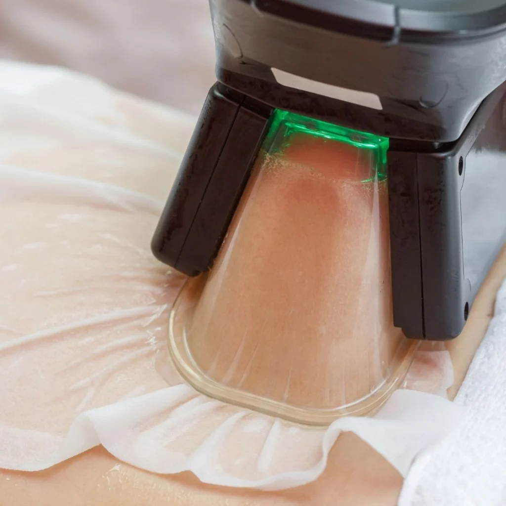 aspiration ventre par cryolipolyse